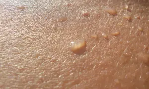 Zbliżenie na skórę z kropelkami potu. Widoczne drobne włoski i nierówności naskórka, sugerujące hiperkeratozę.