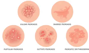 Różne rodzaje łuszczycy: łuszczyca zwykła, odwrotna, krostkowa, plamista i erytrodermia łuszczycowa. Nawet lekka łuszczyca wymaga uwagi.