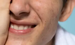 Uśmiechnięta twarz z przebarwieniami, być może melasma, i niedoskonałościami skóry. Dłoń zasłania część nosa.