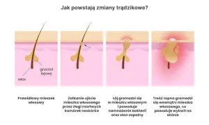 Jak powstaje pryszcz? Poznaj przyczyny i skutki trądziku