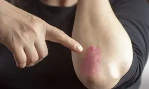 Dłoń wskazuje na łokieć z czerwonymi, suchymi plamami na skórze, które mogą być objawem problemów dermatologicznych.