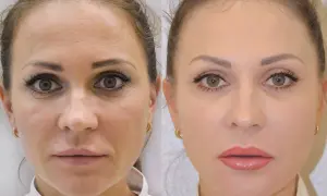 Ile kosztuje kwas hialuronowy na twarz? Ceny zabiegów w Polsce