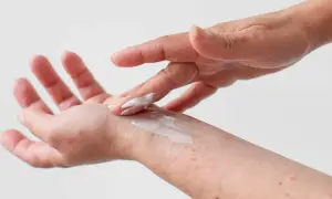 Dłoń z zaczerwienieniami smarowana kremem. Czy atopowe zapalenie skóry jest zaraźliwe? Nie, to choroba autoimmunologiczna.