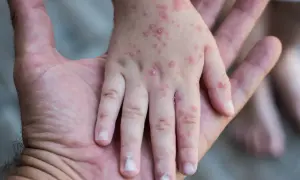 Dziecięca dłoń z licznymi czerwonymi krostkami, objawami świerzbiączki, spoczywa na dużej dłoni dorosłego.