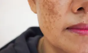 Zbliżenie na twarz kobiety z przebarwieniami. Czy to melasma? Zmiany pigmentacyjne na skórze.