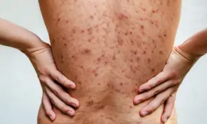 Plecy pokryte licznymi, czerwonymi i ciemnymi zmianami skórnymi, wskazującymi na trądzik piorunujący. Dłonie opierają się na biodrach.