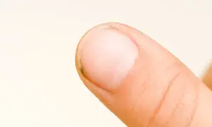 Zbliżenie na palec z widoczną macierzą paznokcia i niewielkim zabrudzeniem pod nim.