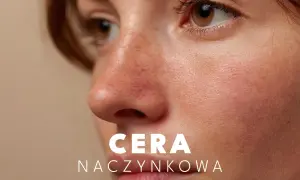 Zbliżenie na twarz z widoczną cerą naczynkową, rumieńcem i piegami.