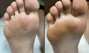 Przed i po: skóra stopy po zabiegu pedicure frezarkowy. Usunięte zrogowacenia, gładka skóra.