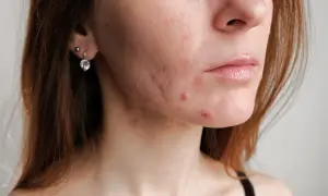 Skóra młodej kobiety z widocznym trądzikiem u dorosłych na policzku i brodzie.