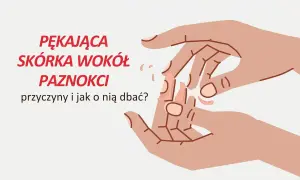 Pękająca skórka wokół paznokci. Ilustracja dłoni z suchymi, łuszczącymi się skórkami przy paznokciach.