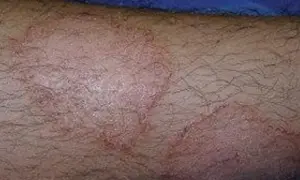 Okrągłe, czerwone wykwity skórne na zarośniętej włosami kończynie, sugerujące problem dermatologiczny.