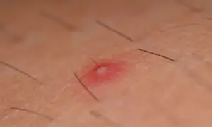 Zapalenie mieszków włosowych pod pachą: czerwona, bolesna krostka z widocznym włosem, otoczona delikatną skórą i innymi włoskami.
