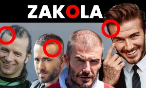 Mężczyźni z widocznymi zakolami i przerzedzonymi włosami. Podkreślone czerwonymi kołami miejsca, gdzie fryzura na rzadkie włosy i zakola jest najbardziej widoczna.