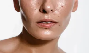 Błyszcząca skóra twarzy z piegami i wypryskami. Czy to sebum? Tak, to naturalny tłuszcz skóry.