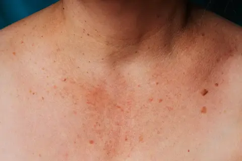 Skóra na dekolcie i szyi z licznymi piegami i plamami wątrobowymi.
