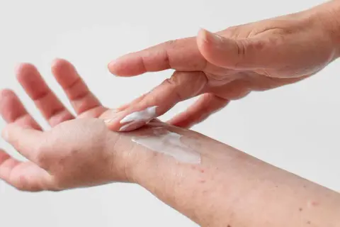 Dłoń z zaczerwienieniami smarowana kremem. Czy atopowe zapalenie skóry jest zaraźliwe? Nie, to choroba autoimmunologiczna.