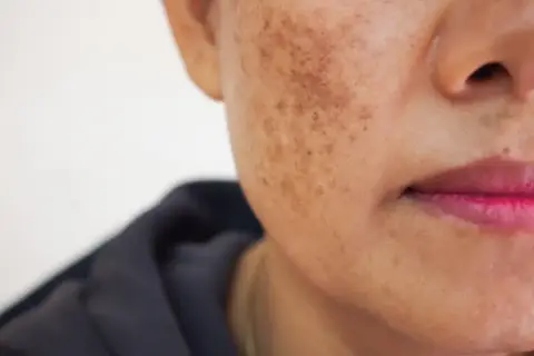Zbliżenie na twarz kobiety z przebarwieniami. Czy to melasma? Zmiany pigmentacyjne na skórze.