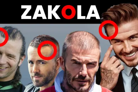 Mężczyźni z widocznymi zakolami i przerzedzonymi włosami. Podkreślone czerwonymi kołami miejsca, gdzie fryzura na rzadkie włosy i zakola jest najbardziej widoczna.