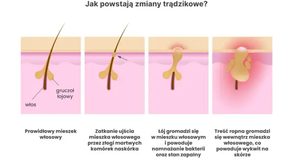 Jak powstaje pryszcz? Poznaj przyczyny i skutki trądziku