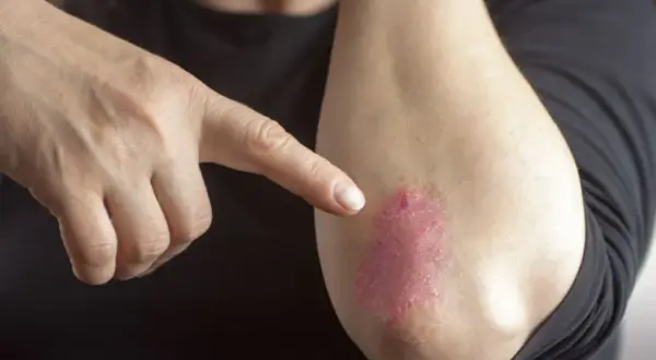 Dłoń wskazuje na łokieć z czerwonymi, suchymi plamami na skórze, które mogą być objawem problemów dermatologicznych.