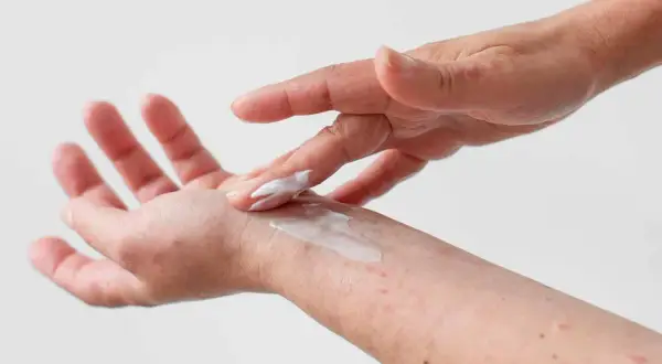 Dłoń z zaczerwienieniami smarowana kremem. Czy atopowe zapalenie skóry jest zaraźliwe? Nie, to choroba autoimmunologiczna.