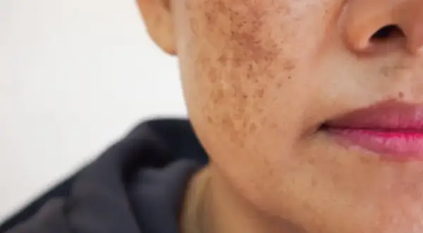 Zbliżenie na twarz kobiety z przebarwieniami. Czy to melasma? Zmiany pigmentacyjne na skórze.