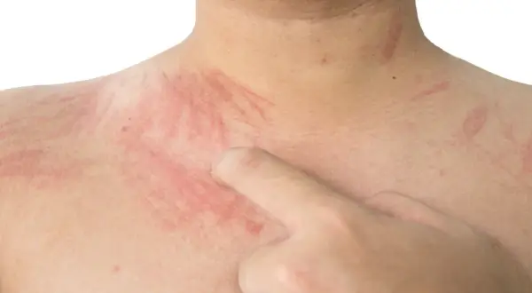Czerwone pręgi na skórze, przypominające dermografizm, mogą być objawem reakcji alergicznej lub problemów z pasożytami.
