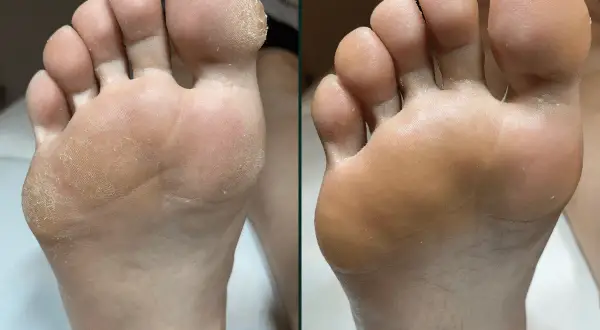 Przed i po: skóra stopy po zabiegu pedicure frezarkowy. Usunięte zrogowacenia, gładka skóra.