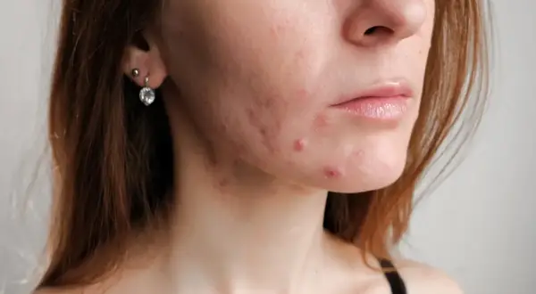 Skóra młodej kobiety z widocznym trądzikiem u dorosłych na policzku i brodzie.
