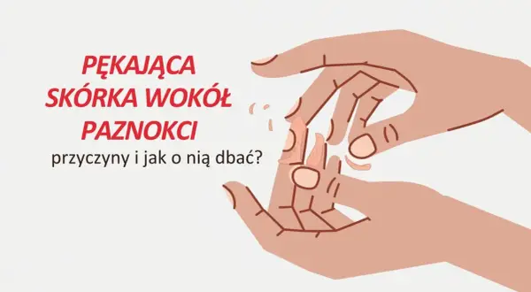 Pękająca skórka wokół paznokci. Ilustracja dłoni z suchymi, łuszczącymi się skórkami przy paznokciach.