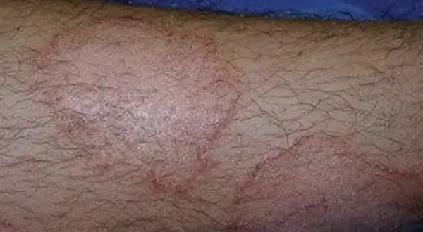 Okrągłe, czerwone wykwity skórne na zarośniętej włosami kończynie, sugerujące problem dermatologiczny.