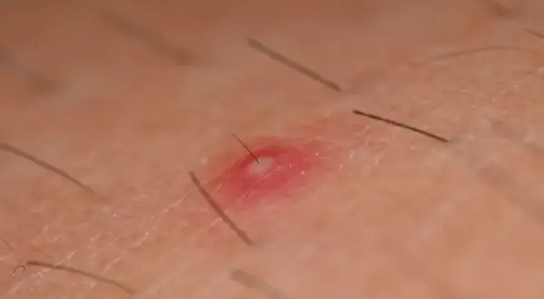 Zapalenie mieszków włosowych pod pachą: czerwona, bolesna krostka z widocznym włosem, otoczona delikatną skórą i innymi włoskami.