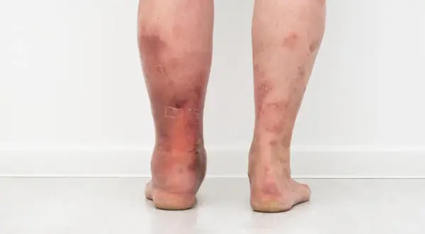 Widoczne zmiany skórne na nogach, objawy egzemy, zaczerwienienie i łuszczenie się skóry.