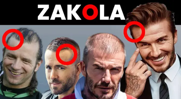 Mężczyźni z widocznymi zakolami i przerzedzonymi włosami. Podkreślone czerwonymi kołami miejsca, gdzie fryzura na rzadkie włosy i zakola jest najbardziej widoczna.