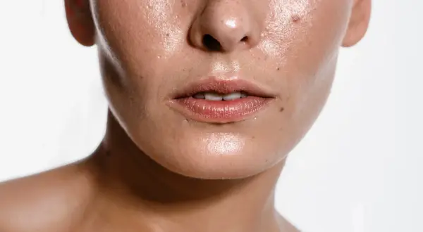 Błyszcząca skóra twarzy z piegami i wypryskami. Czy to sebum? Tak, to naturalny tłuszcz skóry.