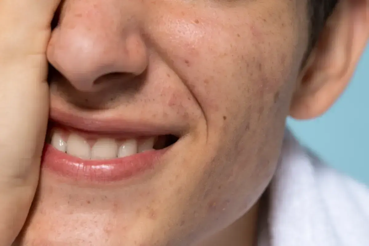 Uśmiechnięta twarz z przebarwieniami, być może melasma, i niedoskonałościami skóry. Dłoń zasłania część nosa.