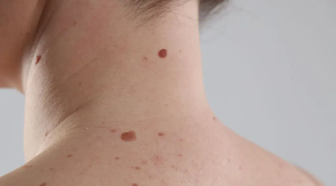 Skóra szyi i ramienia z licznymi pieprzykami o różnym zabarwieniu i wielkości.