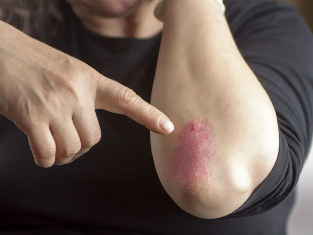 Dłoń wskazuje na łokieć z czerwonymi, suchymi plamami na skórze, które mogą być objawem problemów dermatologicznych.