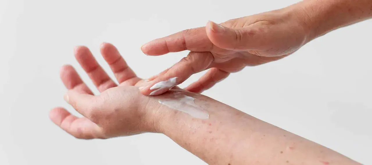 Dłoń z zaczerwienieniami smarowana kremem. Czy atopowe zapalenie skóry jest zaraźliwe? Nie, to choroba autoimmunologiczna.