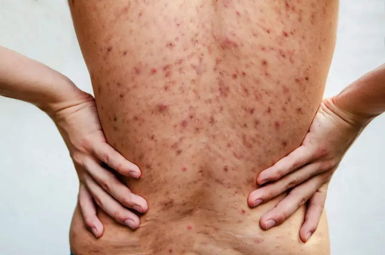 Plecy pokryte licznymi, czerwonymi i ciemnymi zmianami skórnymi, wskazującymi na trądzik piorunujący. Dłonie opierają się na biodrach.