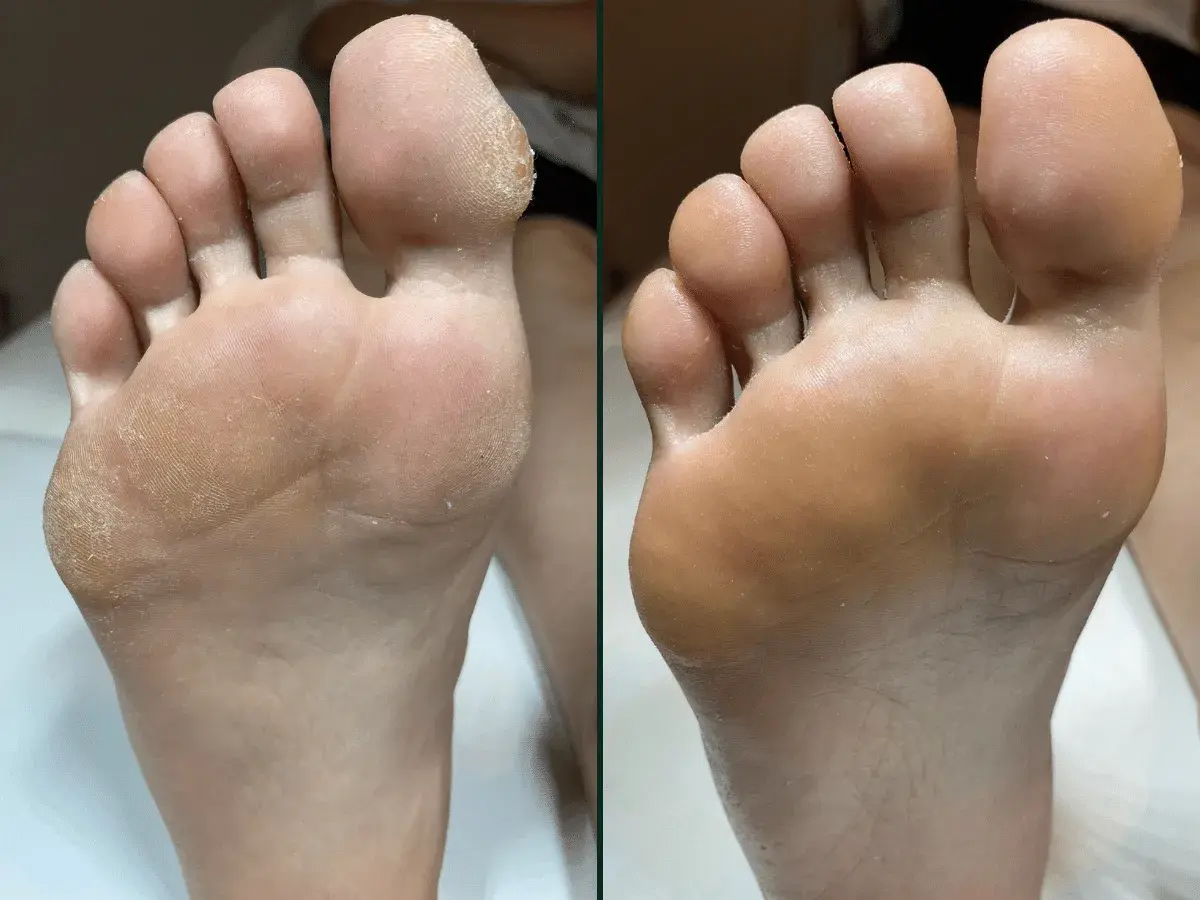 Przed i po: skóra stopy po zabiegu pedicure frezarkowy. Usunięte zrogowacenia, gładka skóra.