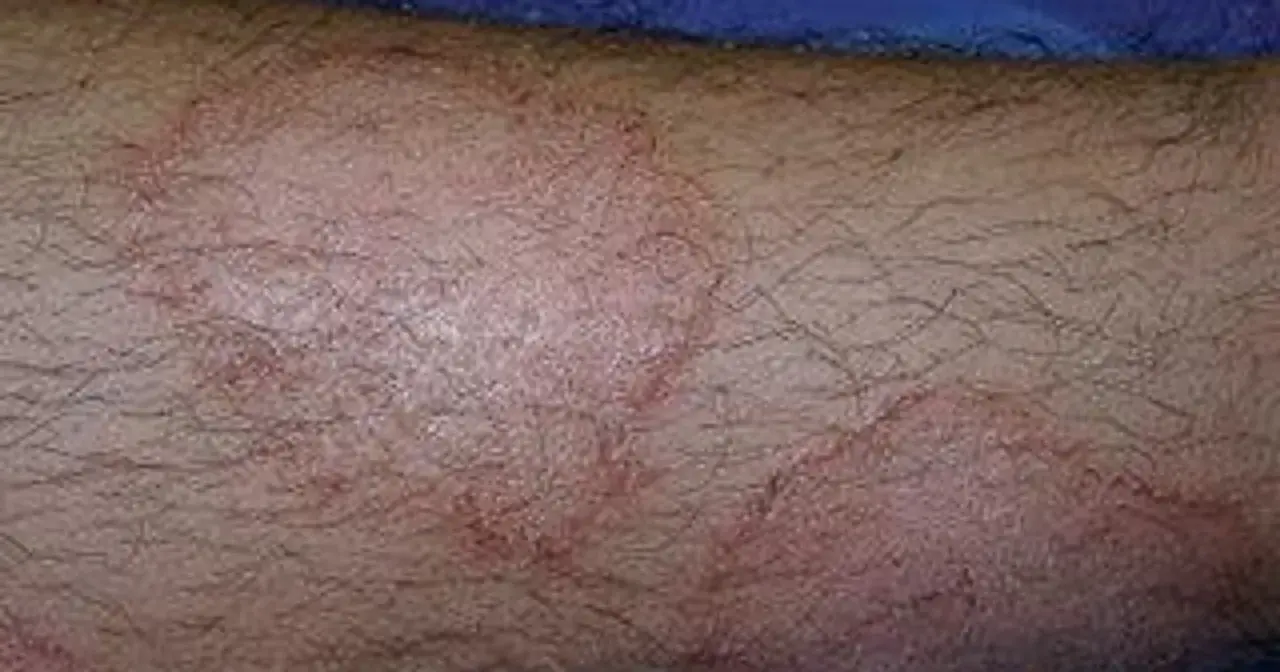 Okrągłe, czerwone wykwity skórne na zarośniętej włosami kończynie, sugerujące problem dermatologiczny.