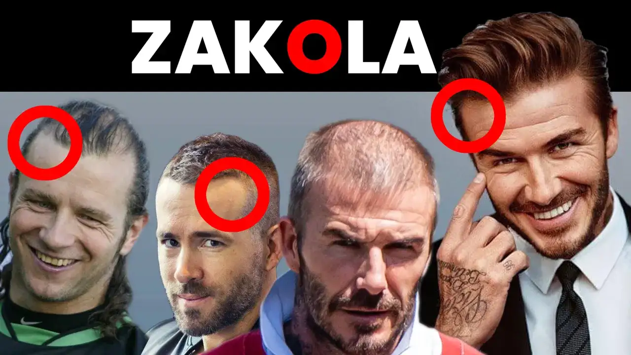 Mężczyźni z widocznymi zakolami i przerzedzonymi włosami. Podkreślone czerwonymi kołami miejsca, gdzie fryzura na rzadkie włosy i zakola jest najbardziej widoczna.