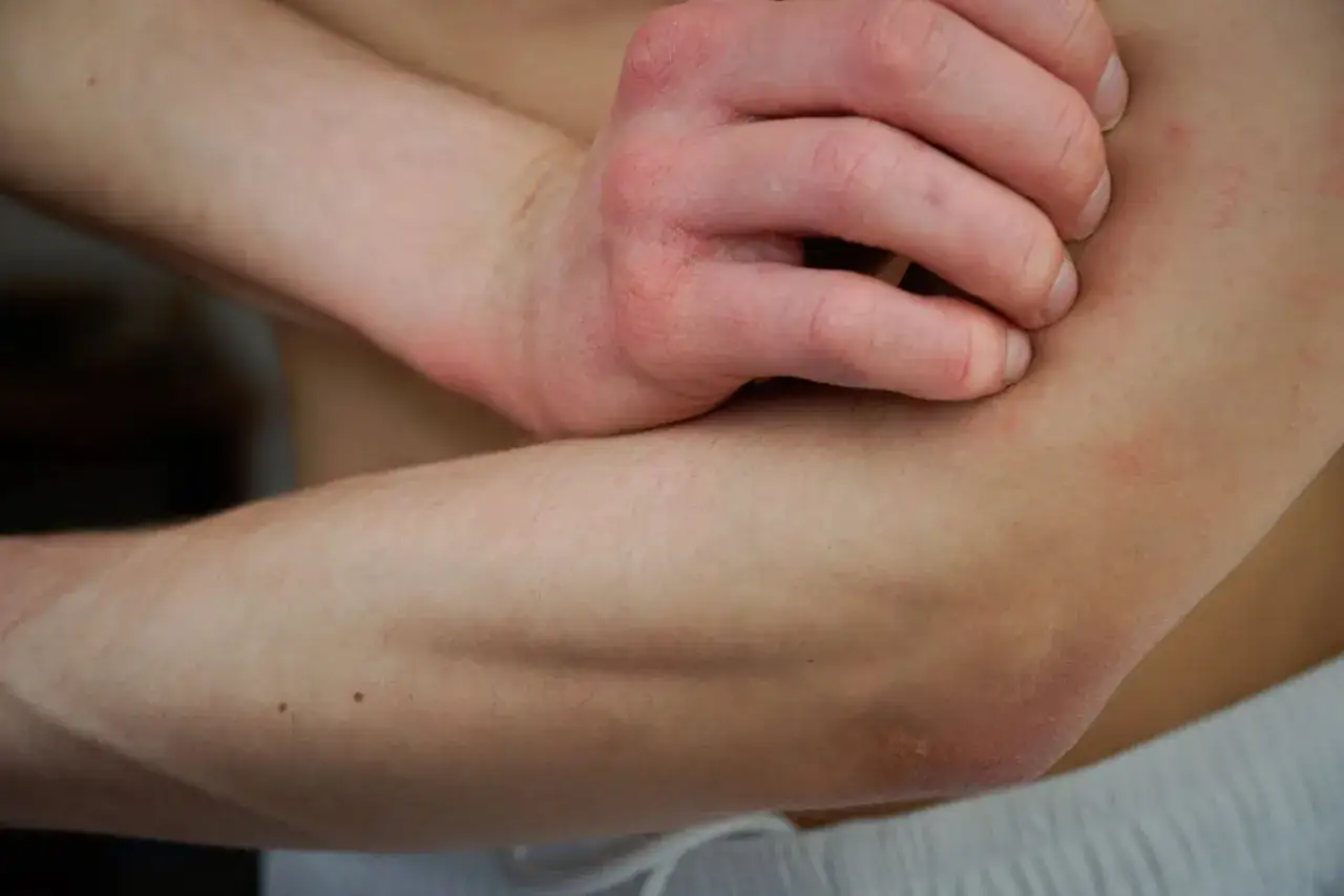 Dłoń drapie ramię z zaczerwienioną, bardzo suchą skórą. Widać drobne krostki i zaczerwienienia.