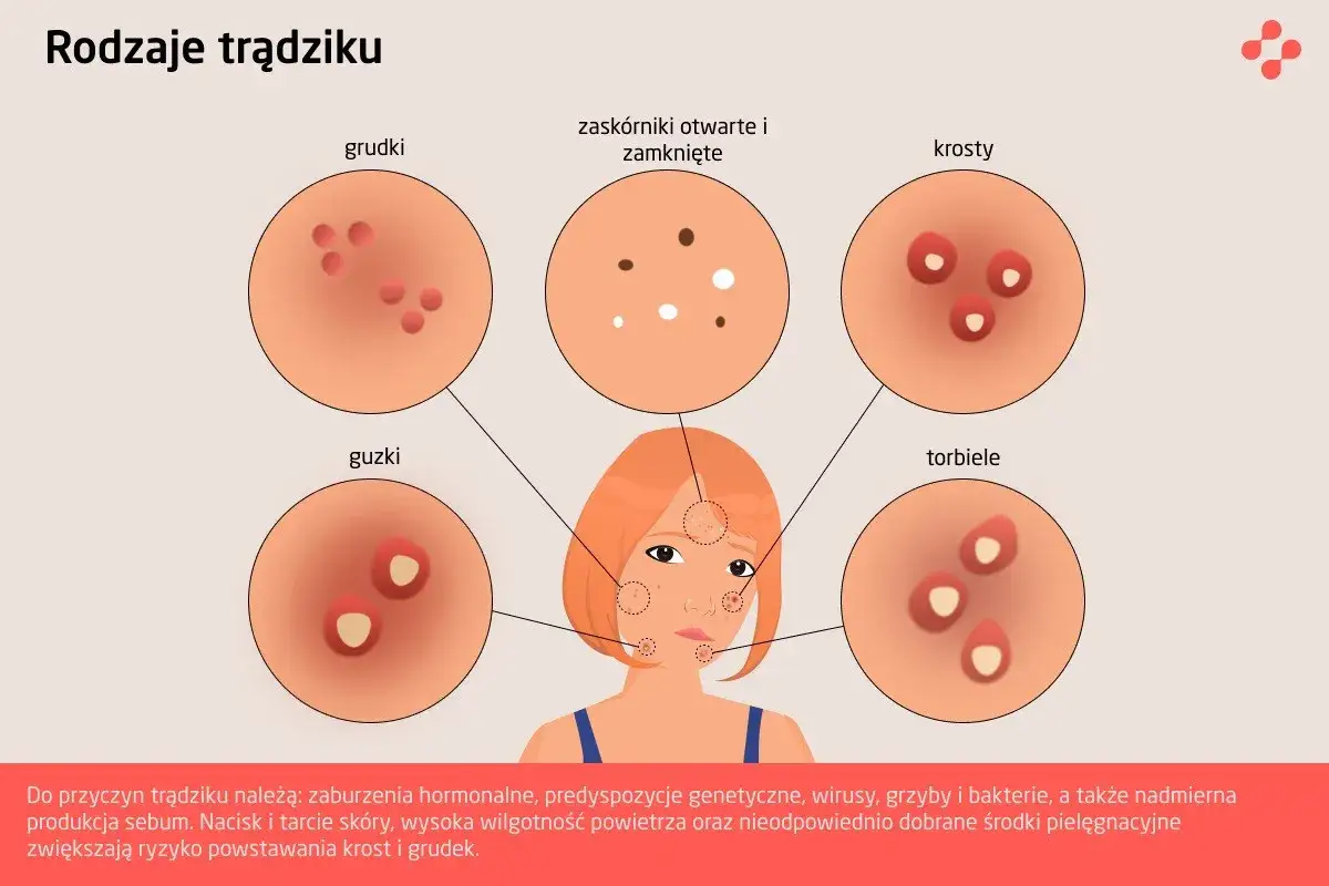 Ilustracja przedstawia różne rodzaje trądziku: grudki, guzki, zaskórniki, krosty i torbiele, pokazując ich wygląd.