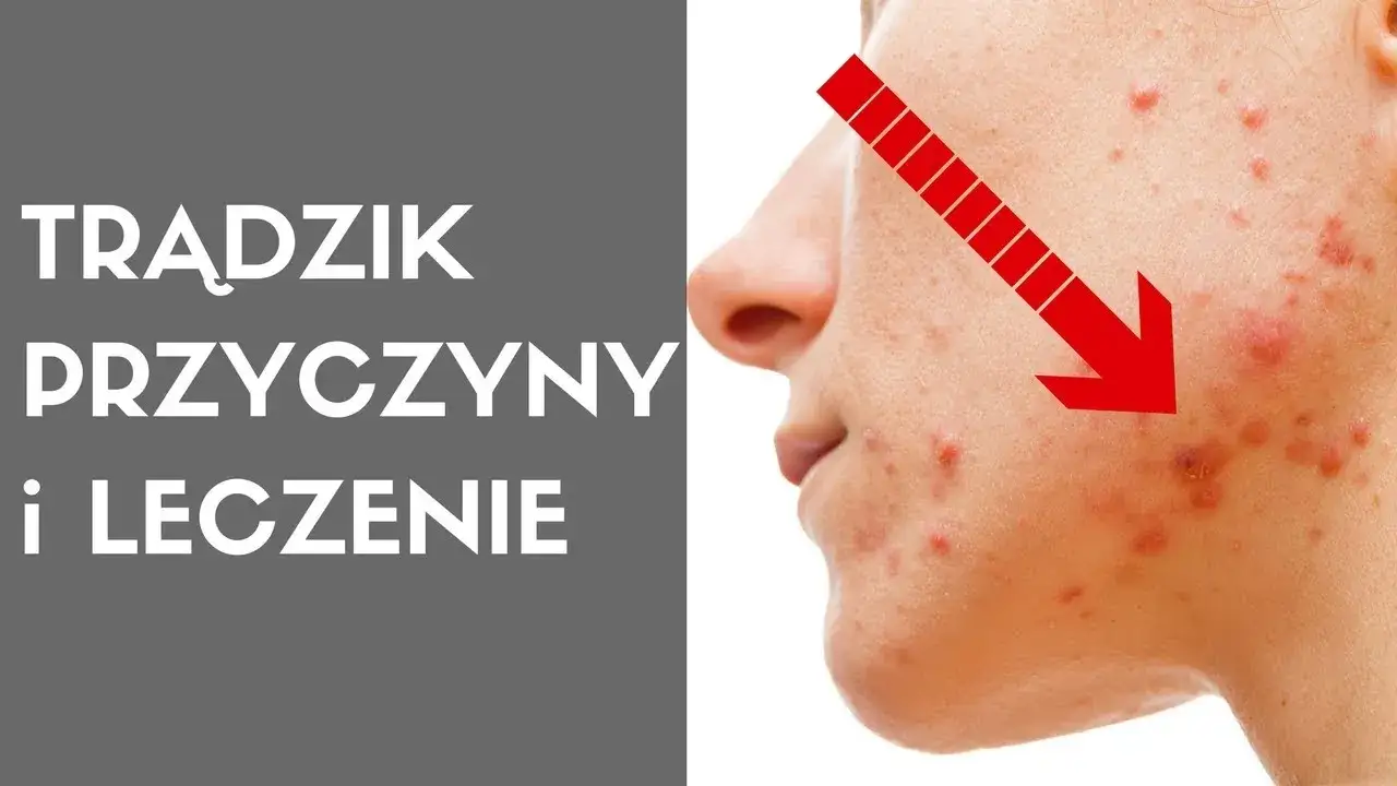 Zdjęcie Jak powstaje pryszcz? Poznaj przyczyny i skutki trądziku