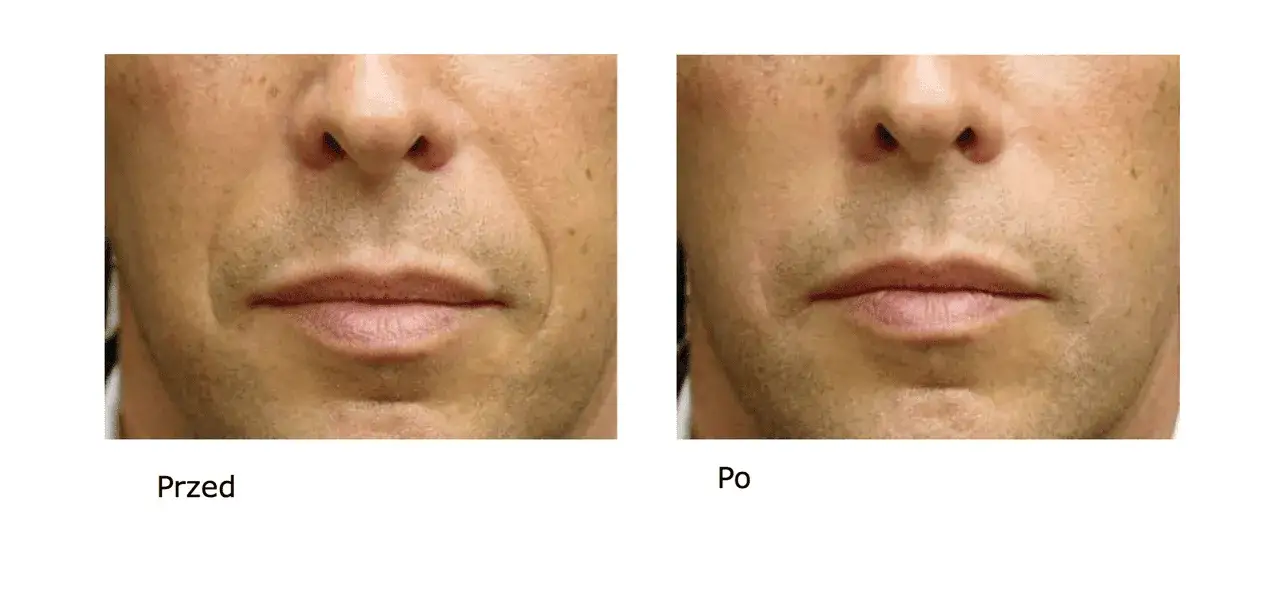 Zdjęcie Jak nakładać kwas hialuronowy, aby uniknąć najczęstszych błędów