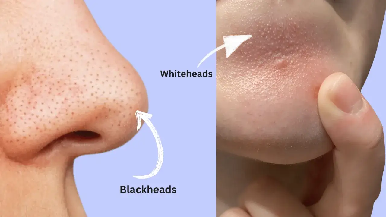 Zbliżenie na skórę z widocznymi wągrami i zaskórnikami. Strzałki wskazują na czarne kropki (blackheads) na nosie i białe krostki (whiteheads) na policzku.