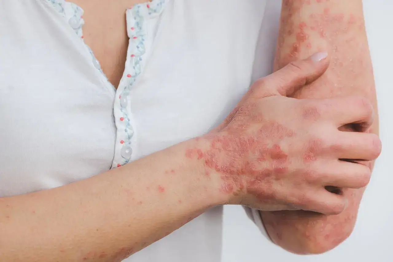Czerwone, łuszczące się plamy na skórze dłoni i przedramienia, wskazujące na problem dermatologiczny.